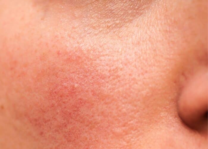Rosacea Awareness Month