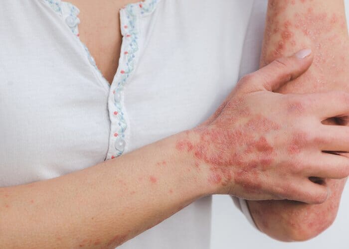 DMK Psoriasis (featured image)