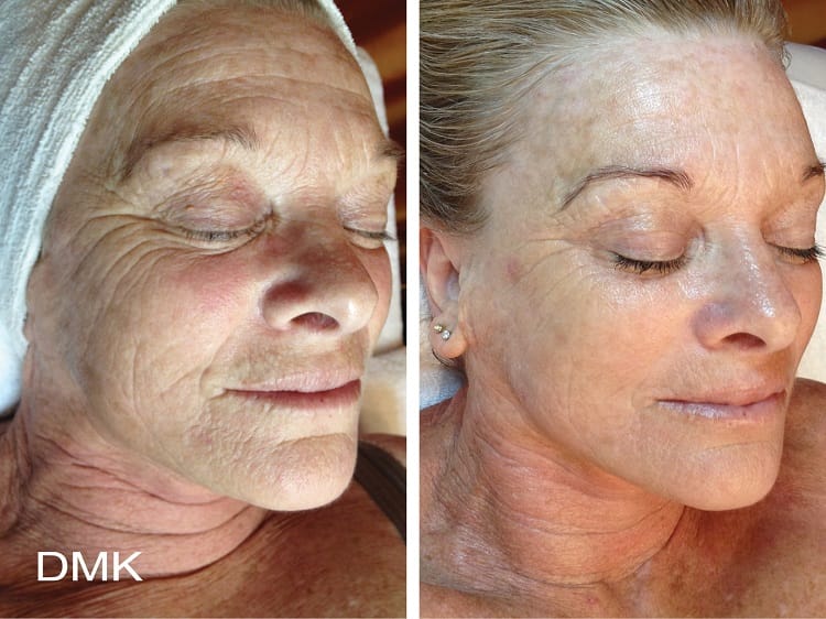dmk ageing 1