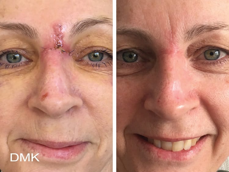 dmk scarring before & after